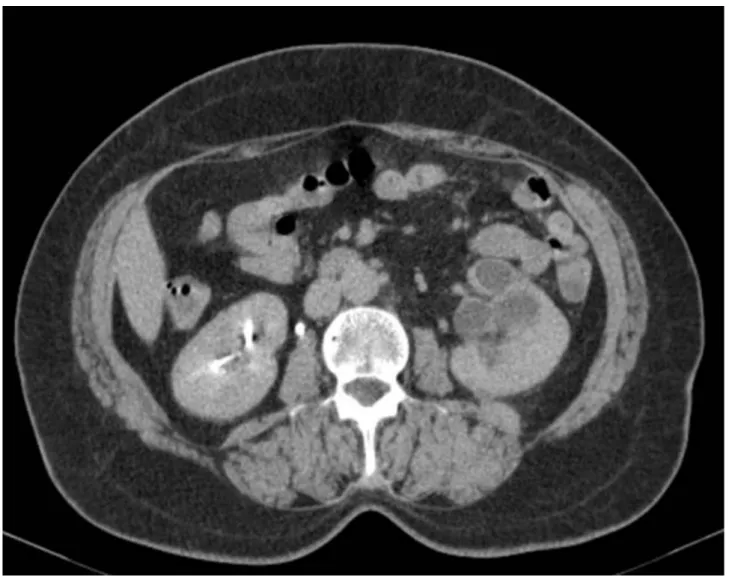 Figura 4 - TAC abdominal de Novembro/2010: Escassa captação de contraste do rim esquerdo, com atrofia cortical, múltiplas áreas  quísticas e estenose da junção uretero-pielicial com espessamento da parede do ureter