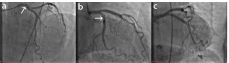 Fig. 3 – a) Occlusive spiral dissection of the left main coronary artery (LMCA) with b) Complete flow obstruction in the  entire left coronary artery system; c) After stent implantation in LMCA, complete left system coronary flow has been 