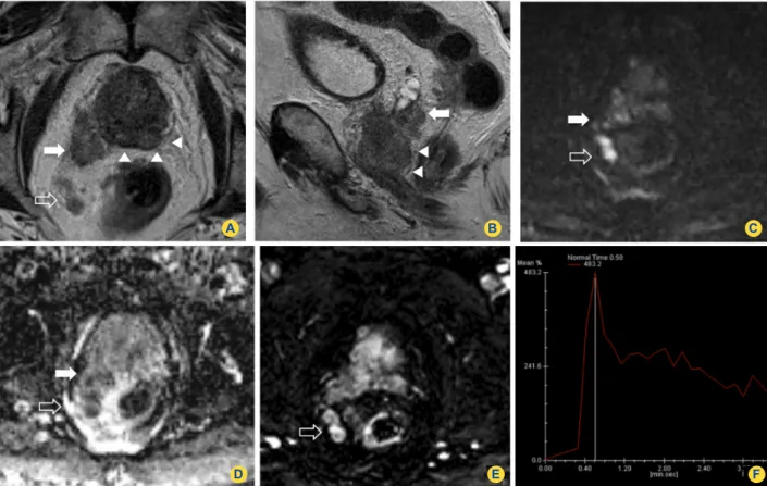 Figure 4 - Images in a 76-year-old man with PSA level of 15,6 ng/mL and biopsy-proven adenocarcinoma (Gleason score of 7)