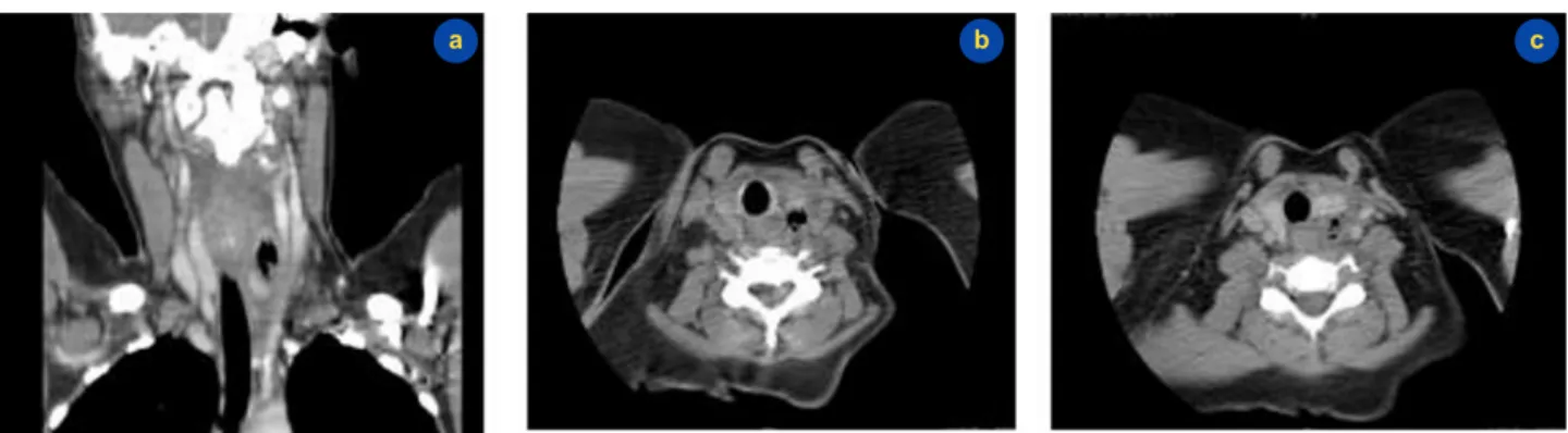 Figure 1 - Cervical CT: left cervical abscess. a) coronal cut; b) and c) axial cuts.