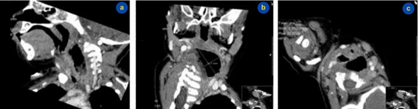 Figure 3 - Cervical CT: retropharyngeal gas forming collection. a) and b) coronal cuts; c) axial cut.