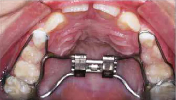 Figure 1 - Modified Hyrax expander.