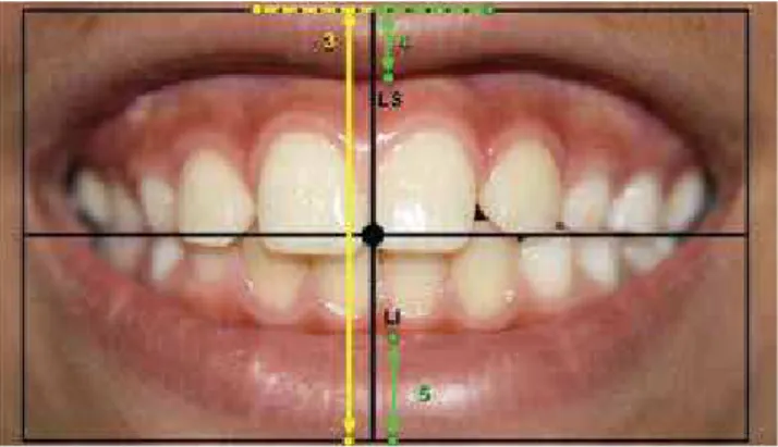 Figure 5 - Vertical measurements of the smile: Smile height and upper  and lower lip thickness.