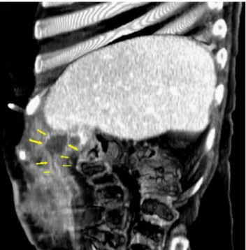 Figure 5 – Transversal enhanced CT image showing right flank subcutaneous irregular collection with significant peripheral fat stranding65%), jejunum (27%), and duodenum (1-3%).4  Regarding this  latter  location,  when  the  gallstone  lodges  at  the duo