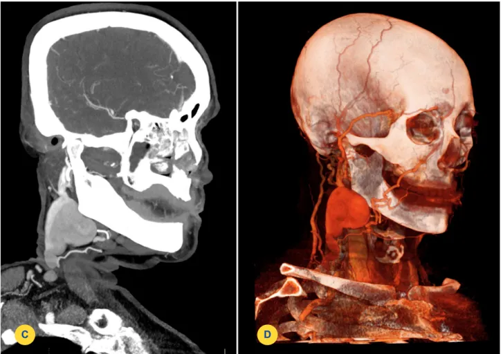 Figura 1 – Aneurisma sacular da veia jugular externa direita. Angio-Tomografia Computorizada dos vasos do pescoço nos planos sagital  oblíquo (C) e imagem de reconstrução pós-processada em volume rendering (D).
