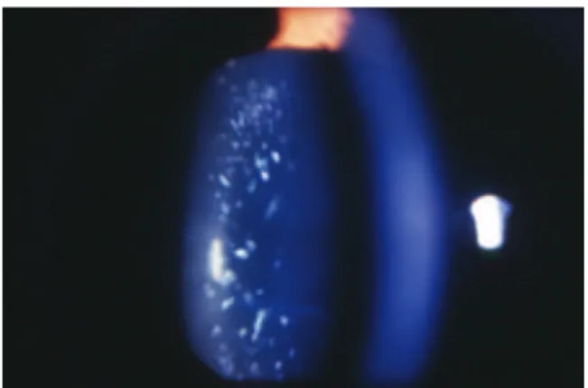 Figure 3.  Pulverulent cataract.
