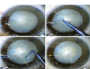 Figure 2. Anterior capsule staining with the solution containing 0.3% lutein/