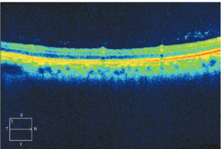 Figure 3. Optical coherence tomography (OCT) of the region, showing perivascular in­