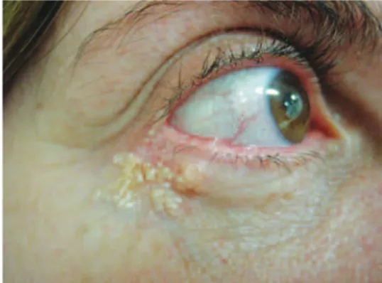 Figure 2 – Preoperative appearance showing  aging of the eyelid. 