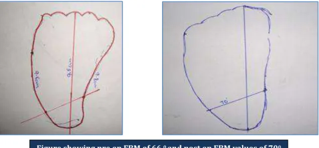 Figure showing pre op FBM of 66  0  and post op FBM values of 70 0 