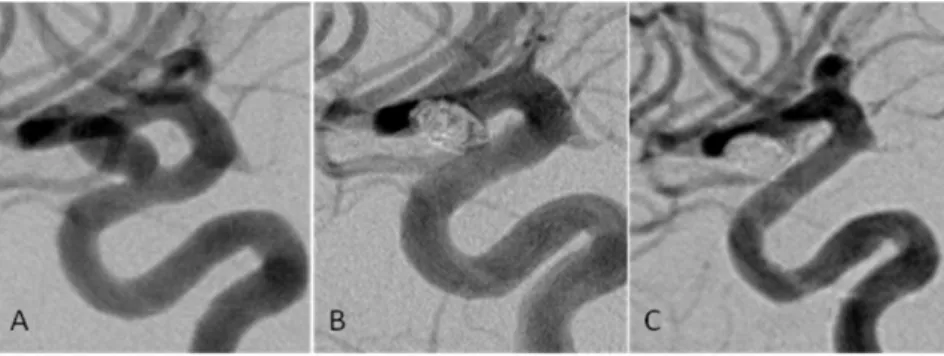 Figure 3. A 64 year old woman presenting with vision impairment was found to have an aneurysm measuring 5 mm that was located in the supraclinoid ICA segment