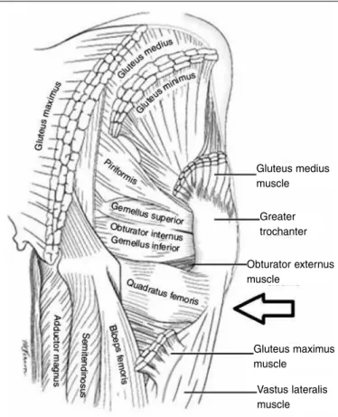 Figure 4 – Posterior view of the hip, intermuscular relationships. Quadratus  femoris muscle (arrow).