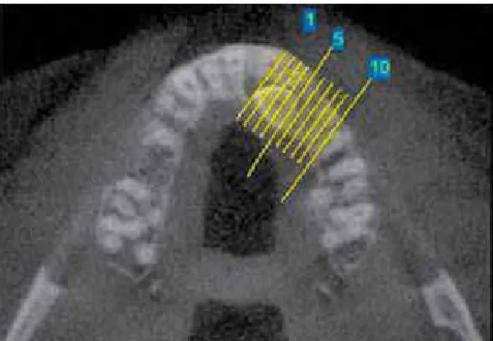 Figure 2 - CT scan for localization of the impacted canine.