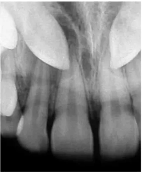 Figure 6 - Periapical radiograph positioning using  the Clark technique with displacement for canine  buccal or palatine position evaluation