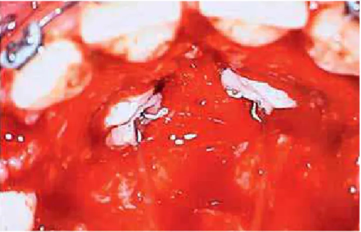 Figure 7 - Bonded accessory during surgical procedure.
