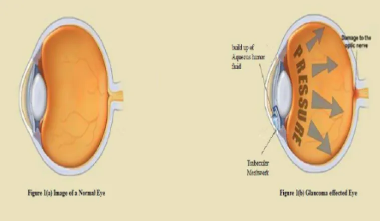 Figure 1 (a) illustrates the eye of a normal person and Figure 1 (b)  shows an effected person with Glaucoma