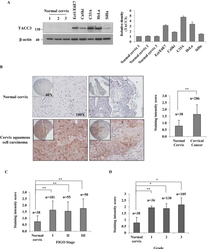 Figure 1. TACC3 is overexpressed in cervical cancer cell lines and tissues. (A) The expression of TACC3 in Ect1/E6E7 (HPV-immortalized ectocervical epithelial), CaSki (HPV-16), C33A (HPV-negative), SiHa (HPV-16) and HeLa (HPV-18) cell lines was determined 