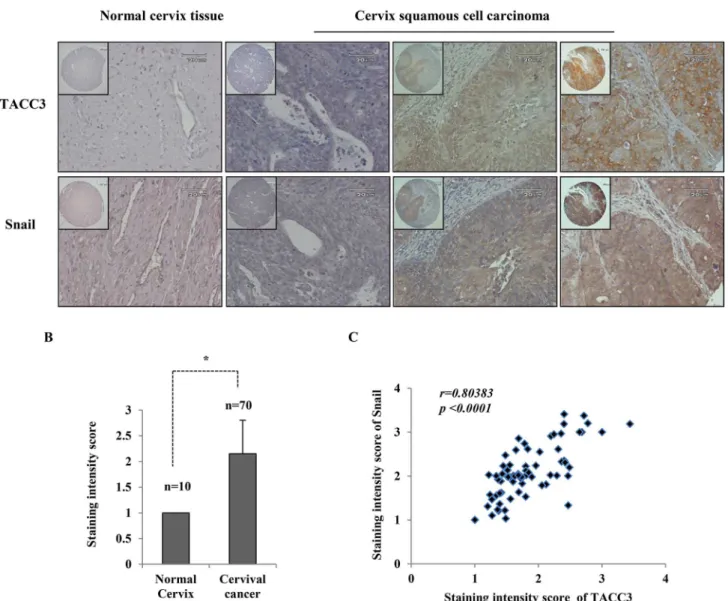 Figure 6. A correlation between TACC3 and Snail expression in cervical cancer tissue microarray