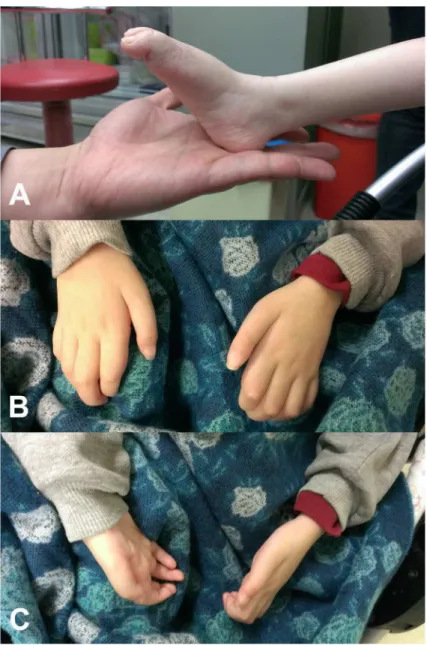 Fig 2. Clinical features of the patient harboring the GARS p.Asp146Tyr mutation. (A) Severe weakness and atrophy of the muscles in the feet and legs, pes planus and (B, C) severe intrinsic hand muscle atrophy with claw hand deformity.