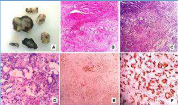 Fig. A. Cut Surface of Appendix showed Thickened Appendiceal  Wall  with  Mucinous  Area  and  Occluded  Lumen,  B