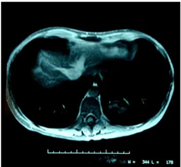Figure  1.  Nuclear  magnetic  resonance  of  the  abdomen  showing  two lesions of 3 cm in the left lobe, segments II-III.