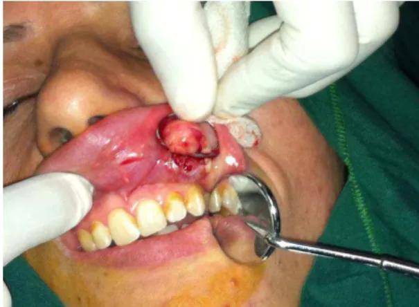 Figure 1. Clinical presentation of a patient with  pleomorphic adenoma 