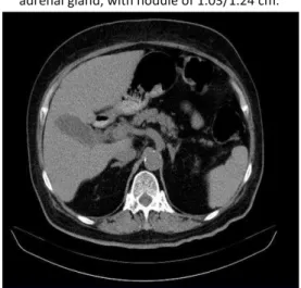 Figure 1.Abdominal CT-showed minimally enlarged right  adrenal gland, with nodule 0.88/0.88 cm; enlarged left 