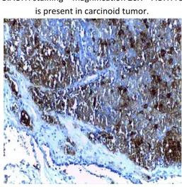Figure 5.ACTH staining  –  magnification 20X  –  ACTH receptor  is present in carcinoid tumor