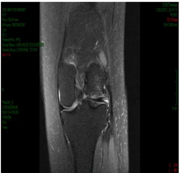 Figure 2 – Preoperative MRI on the right knee.