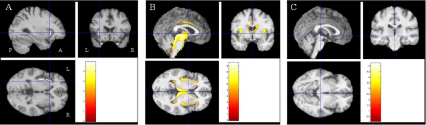 Figure 3. Results of the voxel-based morphometric (VBM) analysis: correlations between grey matter volume and neuropsychological variables in bvFTD patients