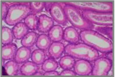 FIGURA  11:  Células  com  epitélio  colunar  pseudo-estratificado  (E)  apresentando  vacuolização  (seta  preta),  ampliação  400x