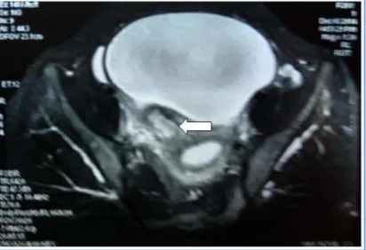 Fig. 3: Axial T2W MR image reveals a Focal lesion along the Right posterior lateral wall of  Urinary bladder which is of Heterogenous signal intensity with hyperintense cystic areas   in the centre (arrow)