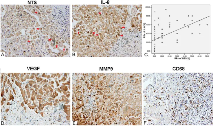 Figure 6. Synchronous increase of NTS and IL-8 proteins in cancer cells closely correlated with the up-regulated inflammatory response in microenvironment of HCC