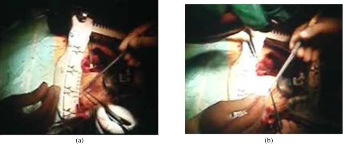 Fig. 4. Multi operation theatre lights on the heart image surface (a) Surgeon’s headlight away from the heart surface (b) Headlight on  the surface of the heart with other lights 