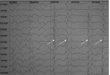 Fig 2. Electroencephalogram showing generalized short periodic tri- tri-phasic wave complexes (arrow)