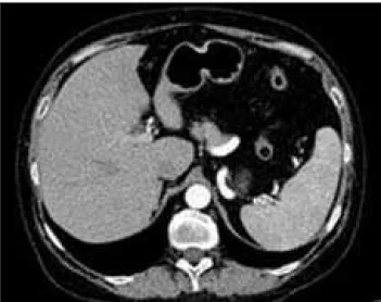 Figure 4. Contrast enhanced abdominal CT after treatment demon- demon-strates spleen of normal size and structure
