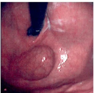Figura 2 - Tomografia Computadorizada de tórax evidenciando hérnia diafragmática posterolateral à esquerda.