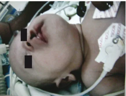 Figura 1.2.1 Imagem pré-operatória de lactente, já anestesiado e em decúbito dorsal, para  correção cirúrgica de fenda palatina e fenda labial
