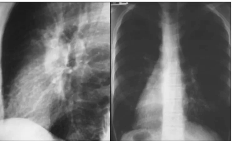Figura 2 – Radiograﬁ as de tórax (perﬁ l e póstero-anterior) de  paciente com síndrome de Kartagener: pulmões hiperinsufl ados  e hipertransparentes
