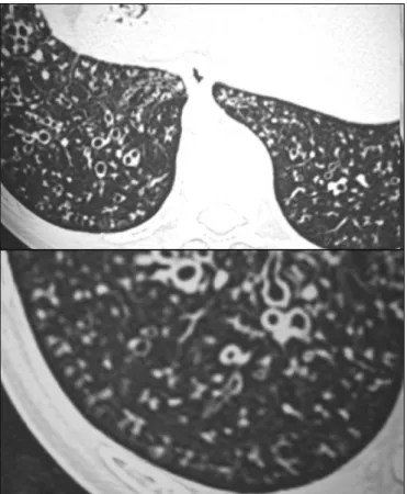 Figura 3 – Tomograﬁ a computadorizada em alta resolução de  paciente com síndrome de Kartagener: imagens com padrão em 
