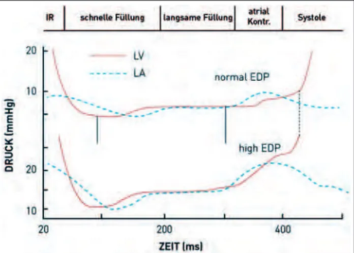 Abbildung 1: Diastole. LV: Left Ventricle; LA: Left Atrium; EDP: End Diastolic Press- Press-ure; IR: Isovolumetric Relaxation
