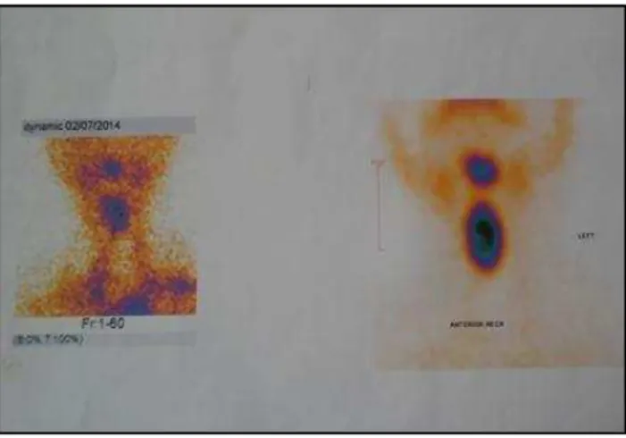 Fig. 2: Radio-Isotope Thyroid Scan showing Both Thyroid  Ectopia (Lingual and Infrahyoid) with Absence of Thyroid 