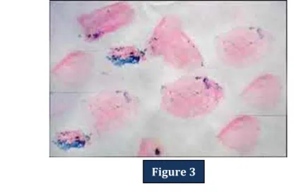 Figure 3: Smear at higher magnification showing clumps of blue colored granules  (Perls' Prussian blue stain, x 400) 