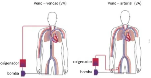 FIGURA 2. Sistema ECMO veno-venoso (VV) e ECMO veno-arterial (VA).