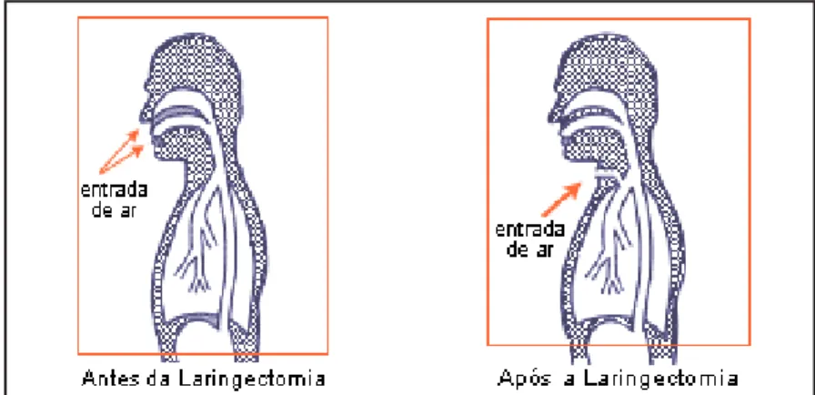 Figura 2 – Respiração pré e pós Laringectomia