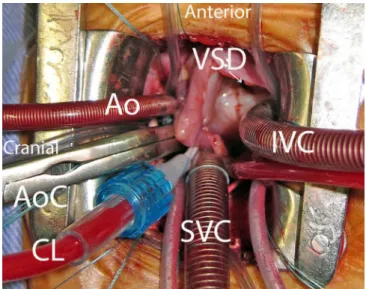 Fig. 1 - Operative surgical ield aspect, with cannulas positioned in  ascending aorta, superior and inferior vena cava