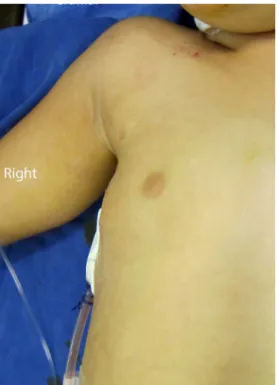 Fig. 2 - Incision aspect at the end of operation Fig. 3 - Aesthetic aspect of the thorax with hidden incision under  the arm