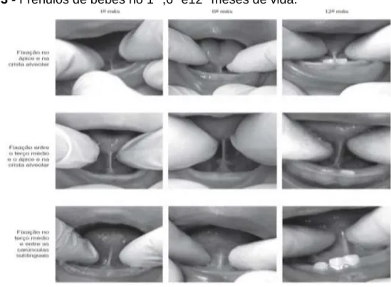 Figura 3 - Frênulos de bebês no 1° ,6º e12° meses de vida. 