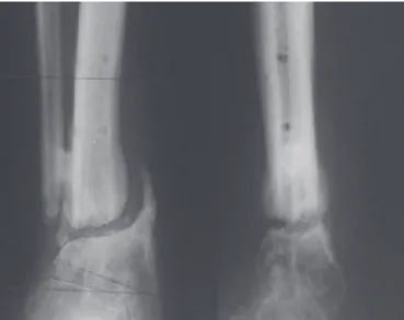 Figura 1 – Imagem radiológica pré-operatória de pseudartrose infectada da tíbia distal