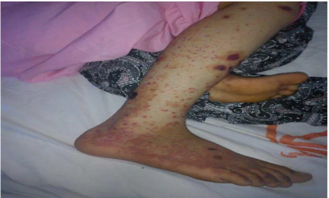 Fig .1: Cutaneous manifestations presented as itchy macules, papules and hemorrhagic crusts in lower  extremities 